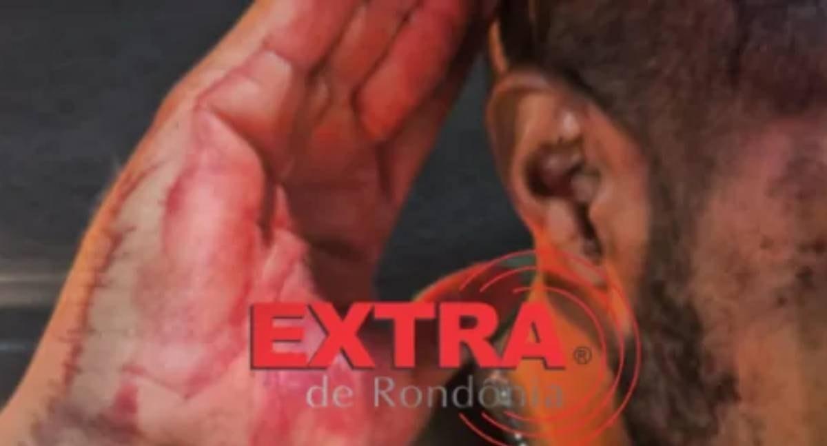 Homem é agredido com taco de sinuca na cabeça no decorrer de discussão em bar de RO